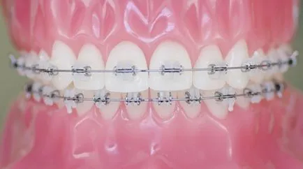 Melyek a önligírozó (bezligaturnye) Braces