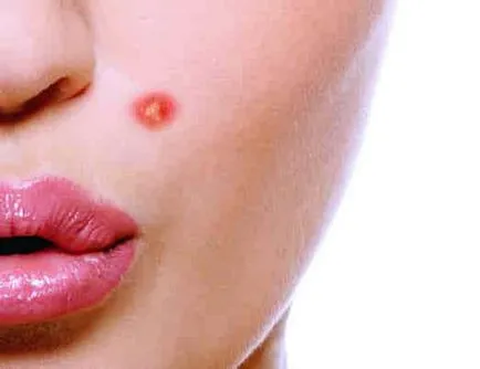 Mi az a rosacea és hogyan kell kezelni őket, mindig formában!