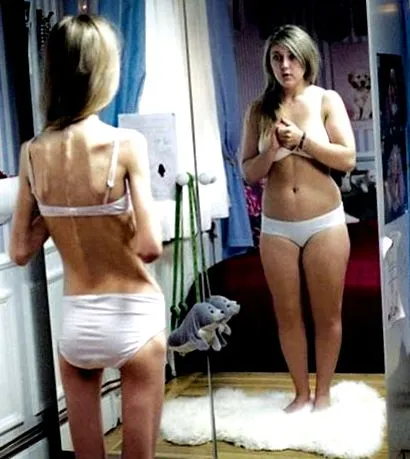anorexia