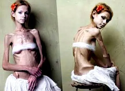anorexia