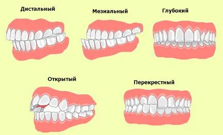 Ckoby a fogakon - javallatok és ellenjavallatok telepítéshez (zárójelben a fogakra fotó) Ckoby a fogak - javallatok és ellenjavallatok a telepítéshez