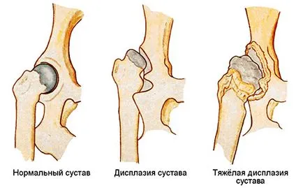 Csípőficam gyermekeknél