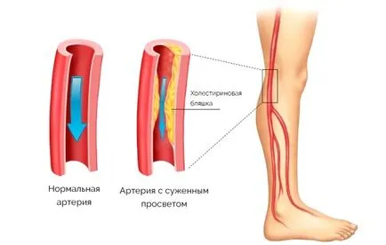 Diabéteszes neuropátia tünetek, kezelés, népi jogorvoslati