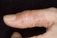 Ekcéma az ujjak okoz és kezelések (ekcéma lábujjak) Ekcéma az ujjak okoz és kezelések