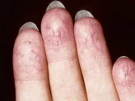 Ekcéma az ujjak fő típusai bőrgyulladások, különösen megnyilvánulásai és a kezelés (ujjak) Ekcéma az ujjak fő típusai bőrgyulladások, különösen tünetei és kezelése