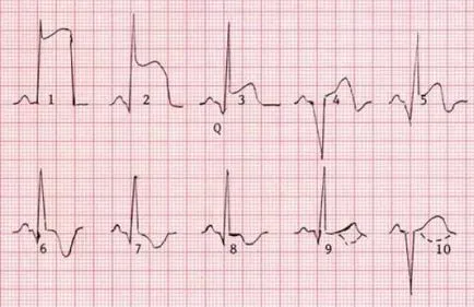 EKG szívinfarktus megfejtése jelek, lokalizáció