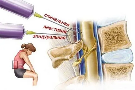 Epidurális érzéstelenítés szülés közben is, a következmények (miután epidurális érzéstelenítés) Epidurális érzéstelenítés szülés közben is, a következmények