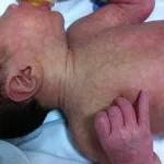 Hypotonia csecsemők tünetei, kezelése
