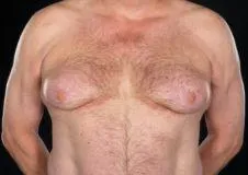 Férfiakban gynecomastia