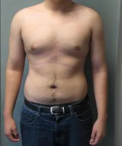 Férfiakban gynecomastia