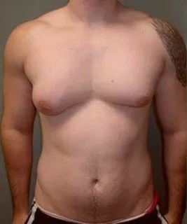 Férfiakban gynecomastia