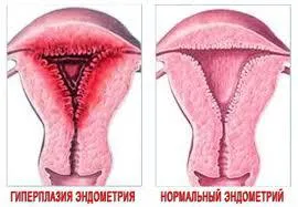 Hyperplasia tünetek, kezelés, leírás