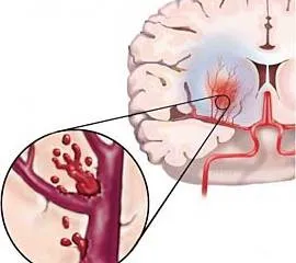 Vérzéses stroke hatások, prognózis, rehabilitáció, a tünetek (vérzés) Vérzéses stroke hatások, prognózis, a rehabilitáció, a tünetek