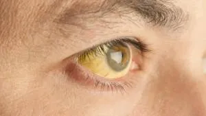 Hyperbilirubinemia jóindulatú újszülöttkori okok, kezelés (amely akkor hiperbilirubinémia) Jóindulatú hiperbilirubinémia, újszülöttkori okok, kezelés