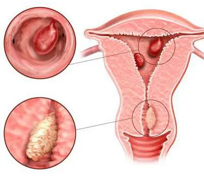 nyaki hipertrófia (cervix hüvelyi szegmens) nyaki megnagyobbodás