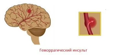 Vérzéses stroke hatások, prognózis, a rehabilitáció, a tünetek (stroke) Vérzéses stroke hatások, prognózis, a rehabilitáció, a tünetek