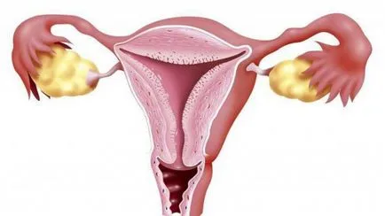 nyaki hipertrófia (vaginális cervikális szegmens) nyaki megnagyobbodás