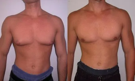 Férfiakban gynecomastia