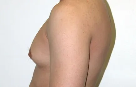 Férfiakban gynecomastia