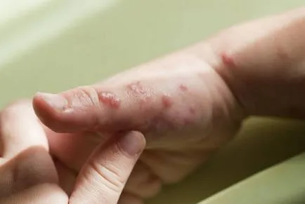 Herpes gyermekek tünetei és kezelése a vírus a gyermek testének