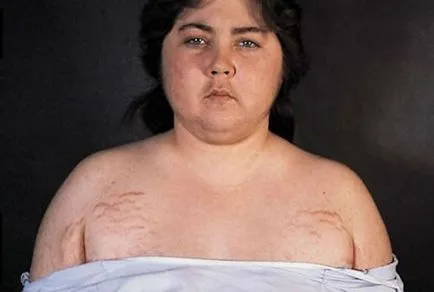 Hyperplasia a mellékvese kéreg és mi az, tünetek, kezelés (hyperplasia) Hyperplasia a mellékvese kéreg és mi az, tünetek, kezelés