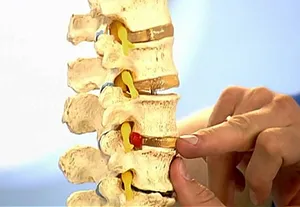 Spinal sérv tünetek és a kezelés, okok és a tünetek, fotó (sérv) Spinal sérv tünetek és a kezelés, okok és a tünetek, fotók