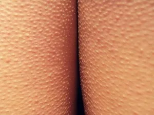 Goosebumps a lábam, hogy megszabaduljon (láb) Goosebumps a lábam, hogy megszabaduljon