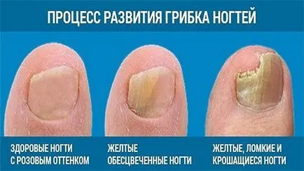 Irunine véleménye, használati utasítások, köröm gomba, ellenjavallatok, ár (Irunine) Irunine véleménye, használati utasítások, köröm gomba, ellenjavallatok, ár
