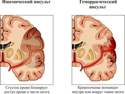 Ischaemiás stroke-ot okok, tünetek, kezelés (ischaemiás) Ischaemiás stroke-ot okok, tünetek, kezelés
