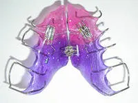 Korrekciója malocclusion gyermekeknél - módszerek, az árak, előtt és után, video (korrekció) Korrekciója malocclusion gyermekeknél - módszerek, az árak, előtti és utáni képek, videók