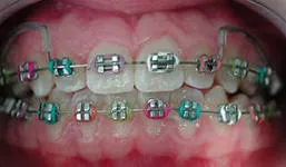 Korrekciója malocclusion gyermekeknél - módszerek, az árak, előtt és után, video (harapás) Korrekciója malocclusion gyermekeknél - módszerek, az árak, előtti és utáni képek, videók