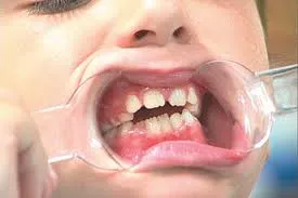 Korrekciója malocclusion gyermekeknél - módszerek, az árak, előtt és után, video (korrekció) Korrekciója malocclusion gyermekeknél - módszerek, az árak, előtti és utáni képek, videók