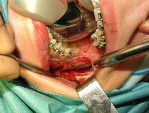 Malocclusion sebészileg - előtti és utáni képek, árak, foglalás