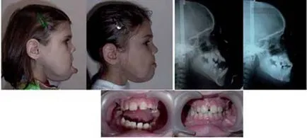 Malocclusion műtétileg - szakaszainak