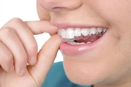 Malocclusion gyermekeknél edző, kappa berendezés lemez (korrekció) Malocclusion gyermekeknél edző, kappa berendezés lemez