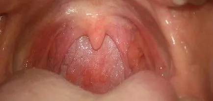 Milyen gyorsan gyógyítja pharyngitis hatásos terápiát (pharyngitis) Milyen gyorsan gyógyítja torokgyulladás hatásos terápiát