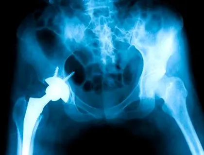 csípő osteoarthritis