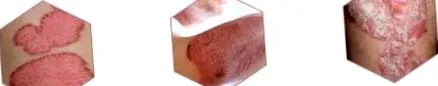 psoridex