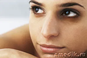 Hogyan lehet megszabadulni a szem alatti karikák