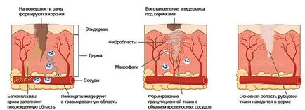 Hogyan lehet megszabadulni a hegek után bárányhimlő, helyi termékek, kozmetikai kezelések