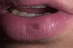 Hogyan kell kezelni a melanoma