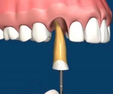 Hogyan kell kezelni a fogak fogorvos fogászati () Hogyan kell kezelni a fogakat a fogorvos