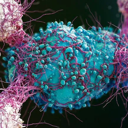 Hogyan kell kezelni a melanoma