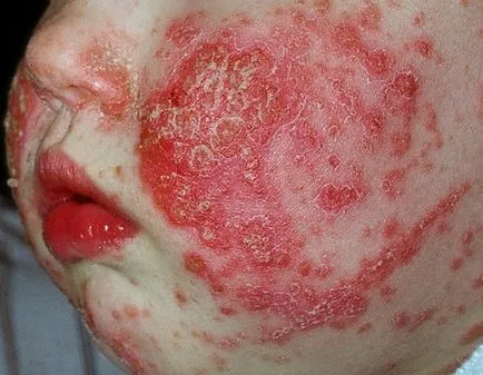 Hogyan lehet megkülönböztetni az allergia a hideg - annak meghatározása, hogy egy felnőtt, légúti, influenza (hideg) Hogyan lehet megkülönböztetni az allergia a hideg - annak meghatározása, hogy egy felnőtt, légúti, influenza