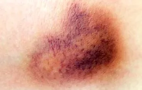 purpura purpura