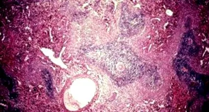 thrombocytopenic purpura