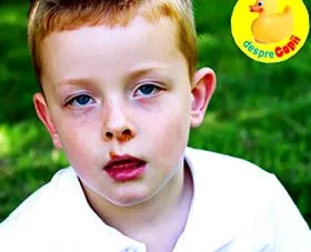 impetigo