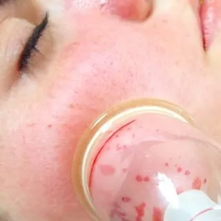 Hogyan lehet megszabadulni a pattanások (acne acne Acne) Hogyan lehet megszabadulni a pattanások