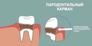 Periodontális tasak curettage és az íny (gumi) Periodontális tasak curettage és az íny