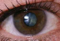 Cataract kezelés népi jogorvoslati 1 (cseppentve szemét reggel) Cataract kezelés népi jogorvoslati 1